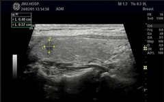 Multimodal Ultrasound Evaluation of Thyroid Nodules