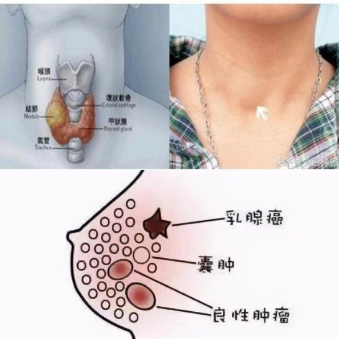Multimodal Ultrasound Examination of Thyroid and Breast Nodules