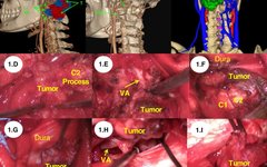 Application of Preoperative Multimodal Imaging Fusion Technology in Complex Skull Base Tumor Surgery
