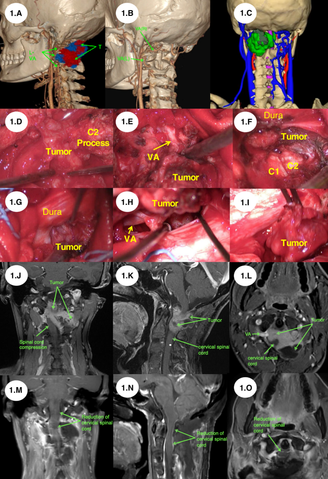 Application of Preoperative Multimodal Imaging Fusion Technology in Complex Skull Base Tumor Surgery