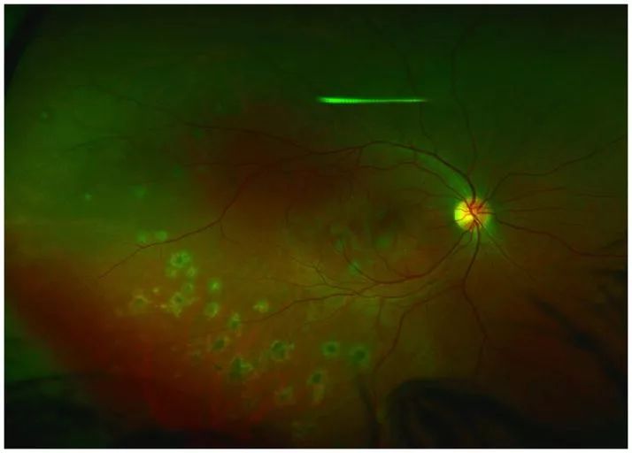 Understanding Multifocal Choroiditis Through Angio-OCT