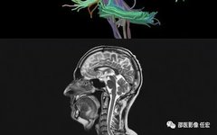 Diffusion Tensor Imaging (DTI) in Brain Structure Analysis