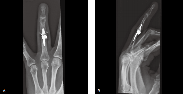 MCP And PIP Joint Arthroplasty - AAOS Orthopedic Postoperative Rehabilitation Guidelines