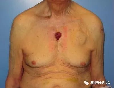 Merkel Cell Carcinoma Is Not Derived From Merkel Cells!