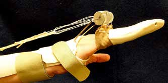 MCP And PIP Joint Arthroplasty - AAOS Orthopedic Postoperative Rehabilitation Guidelines