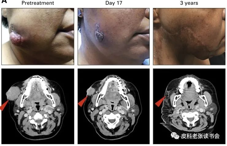 Merkel Cell Carcinoma Is Not Derived From Merkel Cells!
