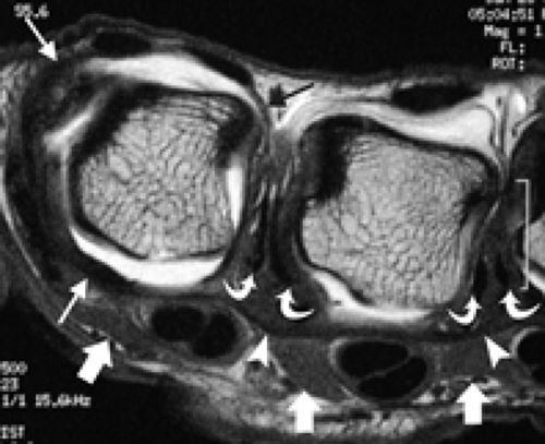 MRI of Finger Tendons