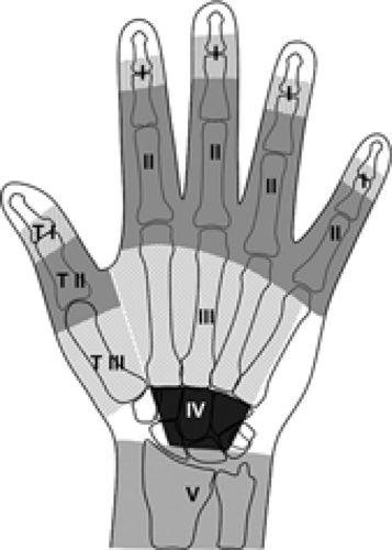 MRI of Finger Tendons