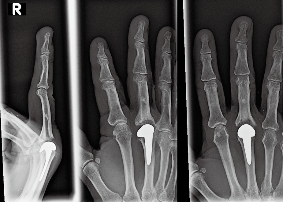 MCP And PIP Joint Arthroplasty - AAOS Orthopedic Postoperative Rehabilitation Guidelines