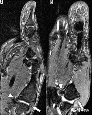 Latest Review: MRI Diagnostic Techniques for Little Finger and Thumb