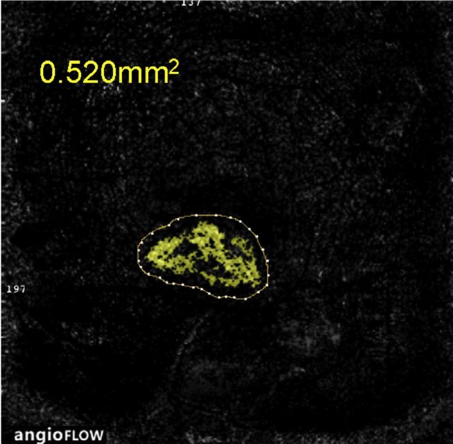 Understanding Multifocal Choroiditis Through Angio-OCT