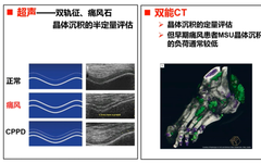 Diagnosis And Differential Diagnosis Of Common Crystal Arthropathies
