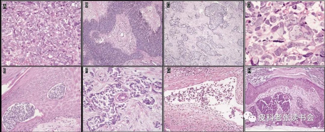 Merkel Cell Carcinoma Is Not Derived From Merkel Cells!