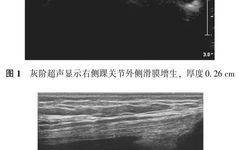 Applications Of Musculoskeletal Ultrasound In Rheumatoid Arthritis Diagnosis And Treatment