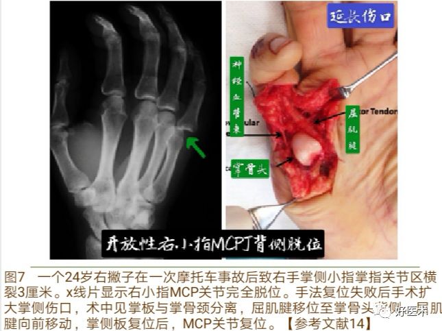Key Points in the Diagnosis and Treatment of Metacarpophalangeal Joint Dislocation
