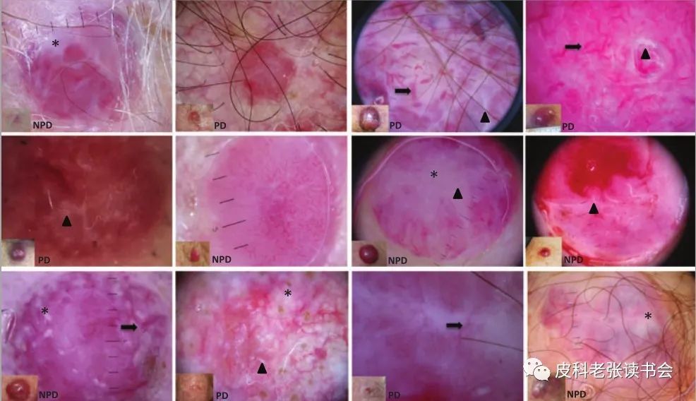Merkel Cell Carcinoma Is Not Derived From Merkel Cells!