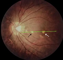 Understanding Multifocal Choroiditis Through Angio-OCT