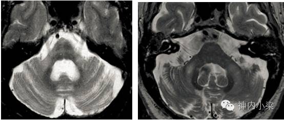 Summary of Lesions in the Middle Cerebellar Peduncle