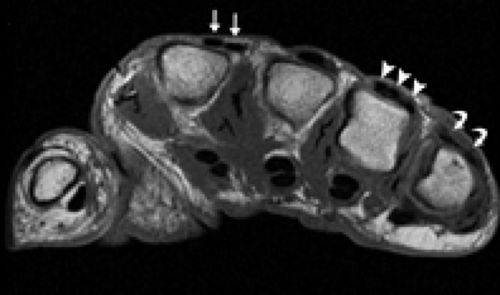 MRI of Finger Tendons
