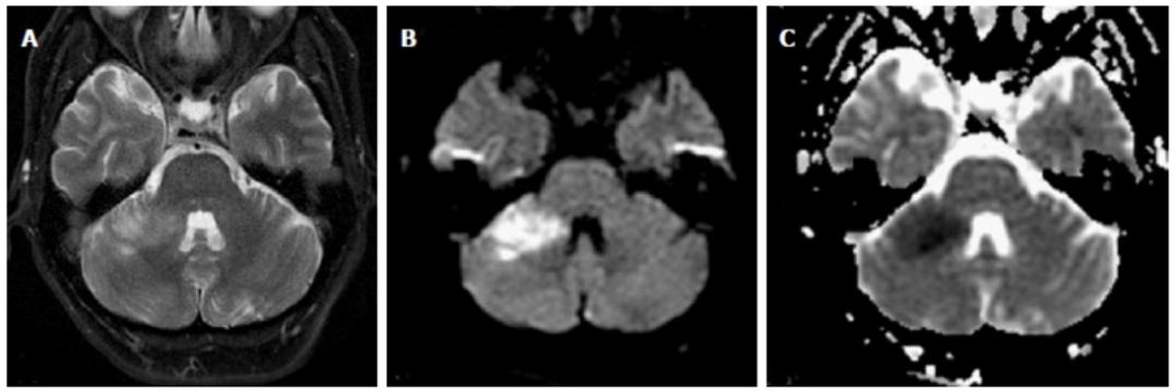 Exploring the Mystery of Middle Cerebellar Peduncles
