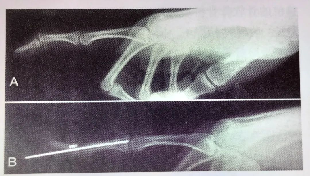 Key Points of Three Types of Hand Joint Injuries