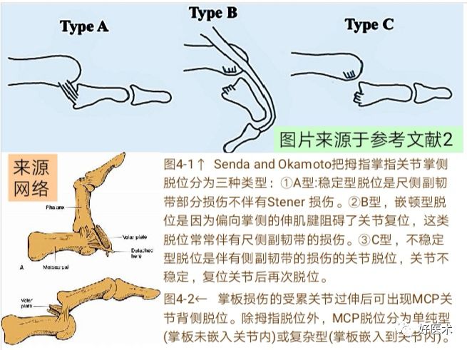 Key Points in the Diagnosis and Treatment of Metacarpophalangeal Joint Dislocation