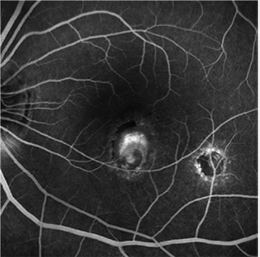 Understanding Multifocal Choroiditis Through Angio-OCT