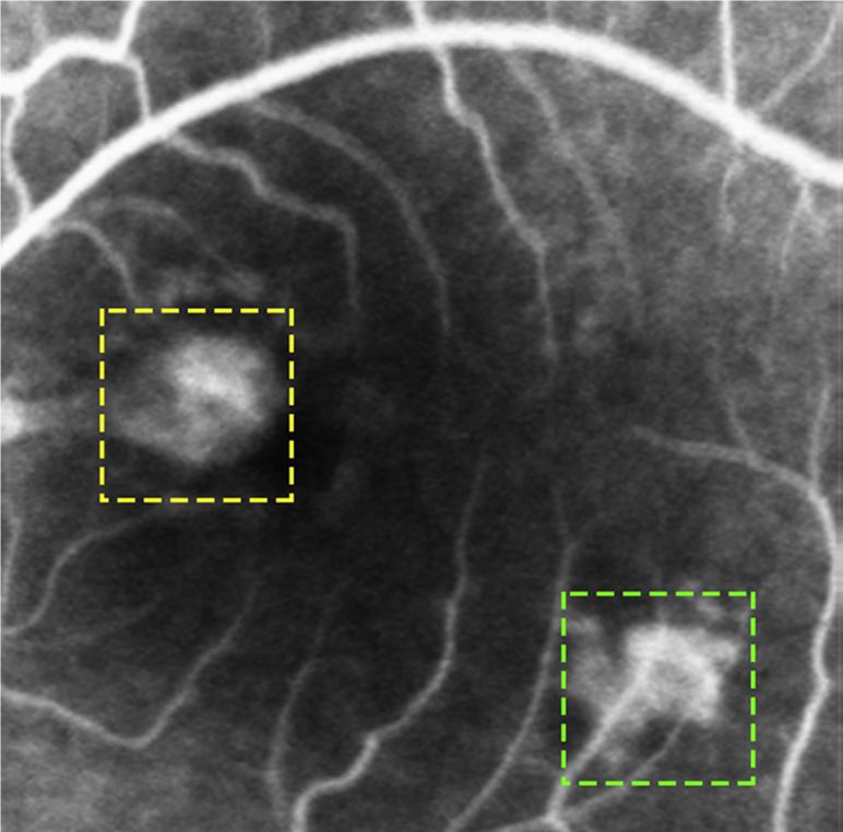 Understanding Multifocal Choroiditis Through Angio-OCT