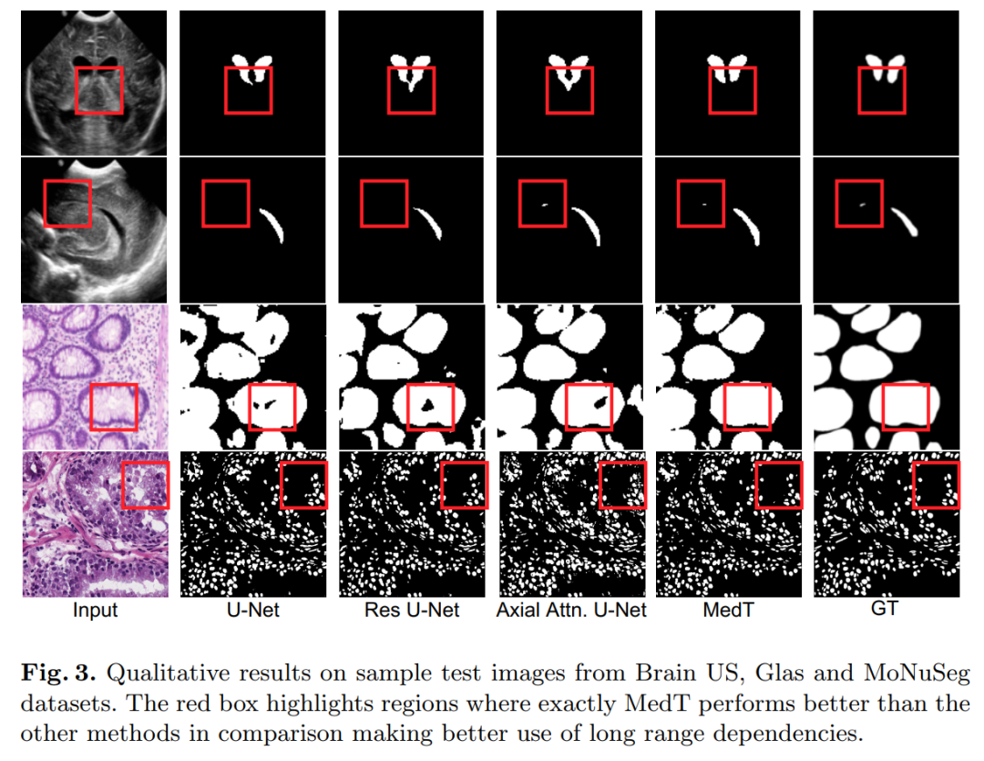 When Transformer Meets U-Net: A Review of Medical Image Segmentation