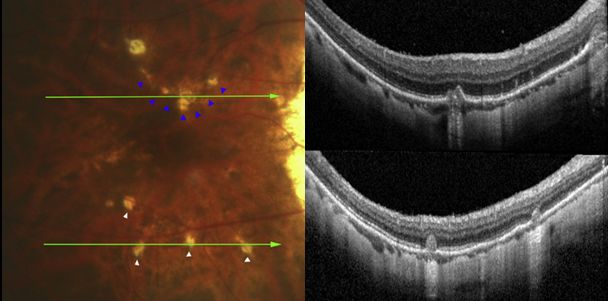 Understanding Multifocal Choroiditis Through Angio-OCT