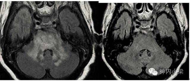 Summary of Lesions in the Middle Cerebellar Peduncle