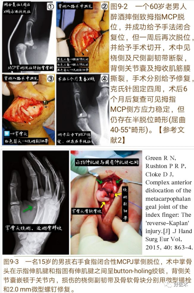 Key Points in the Diagnosis and Treatment of Metacarpophalangeal Joint Dislocation
