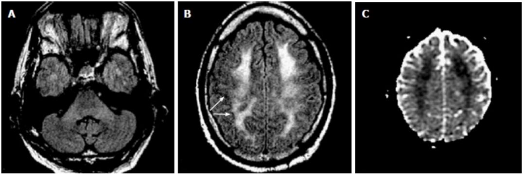 Exploring the Mystery of Middle Cerebellar Peduncles
