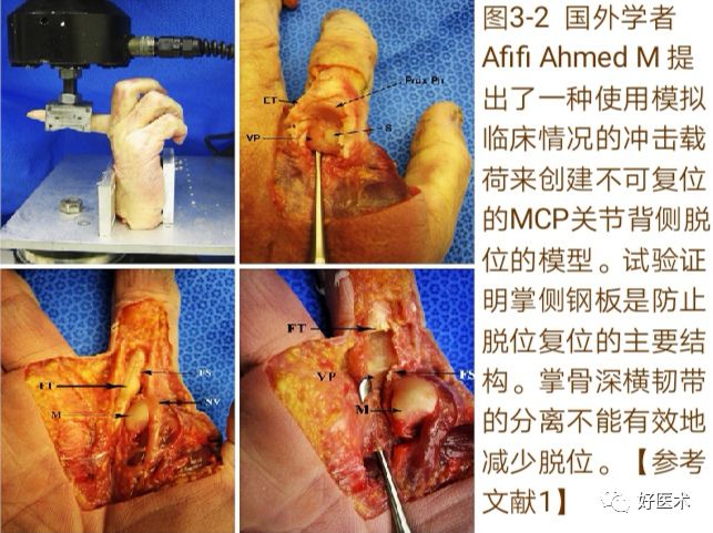 Key Points in the Diagnosis and Treatment of Metacarpophalangeal Joint Dislocation