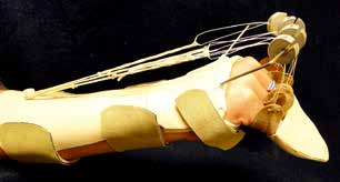 MCP And PIP Joint Arthroplasty - AAOS Orthopedic Postoperative Rehabilitation Guidelines
