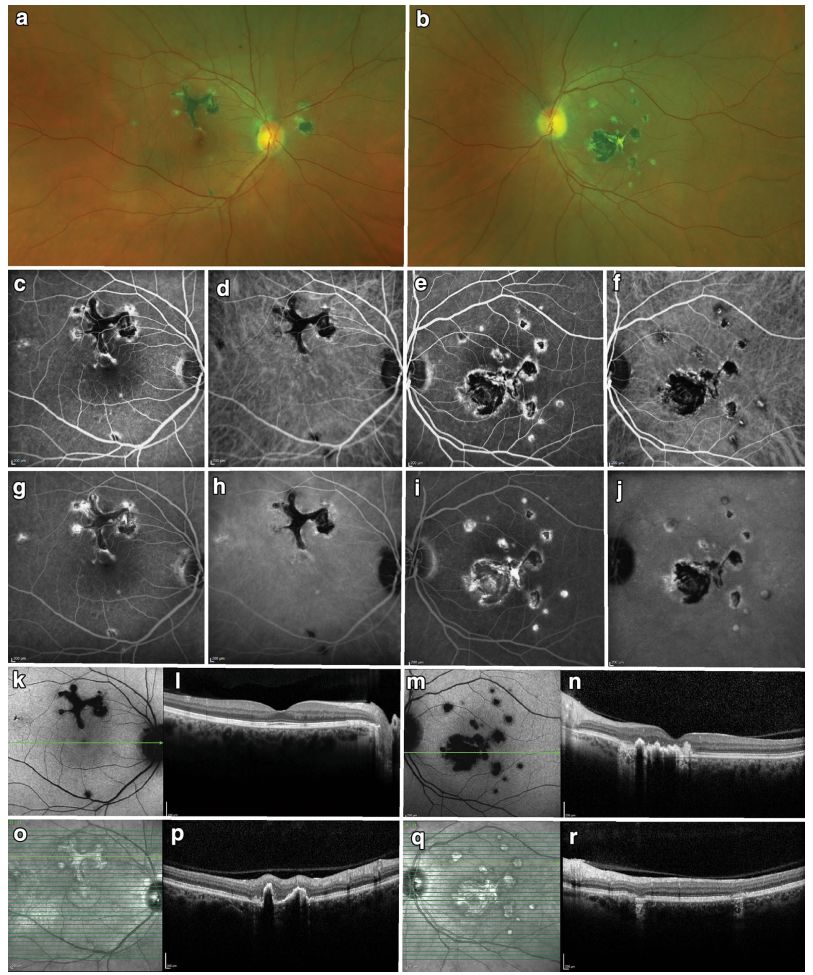 Comprehensive Guide to White Dot Syndromes