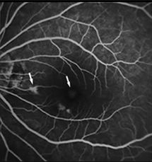 Understanding Multifocal Choroiditis Through Angio-OCT