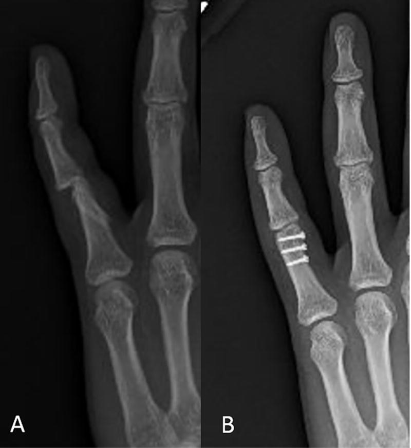 Key Points of Three Types of Hand Joint Injuries