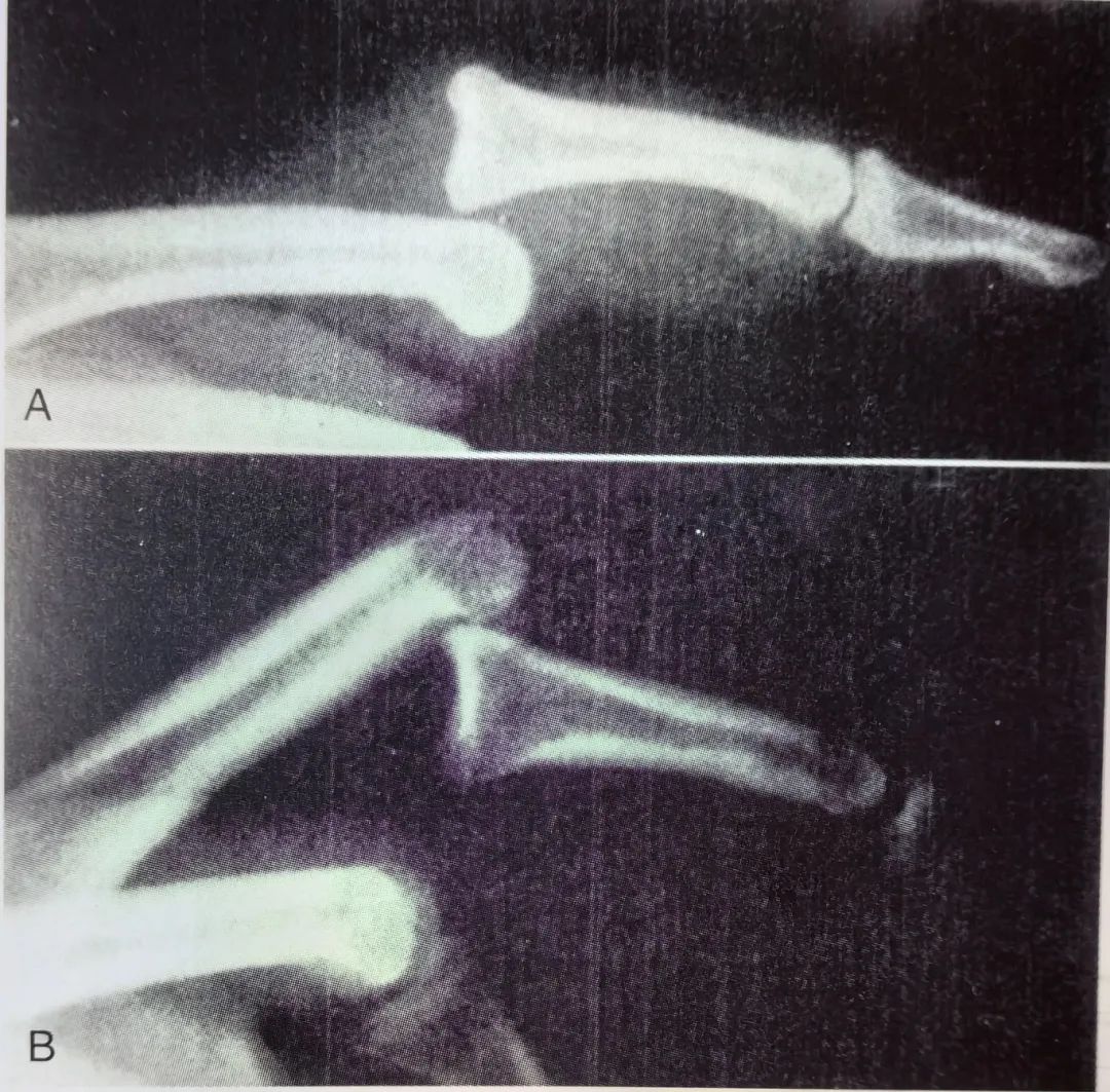 Key Points of Three Types of Hand Joint Injuries