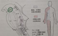 Claude Syndrome: Clinical Report and Analysis