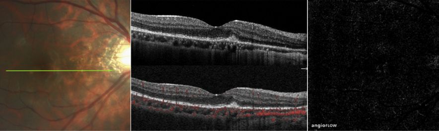 Understanding Multifocal Choroiditis Through Angio-OCT
