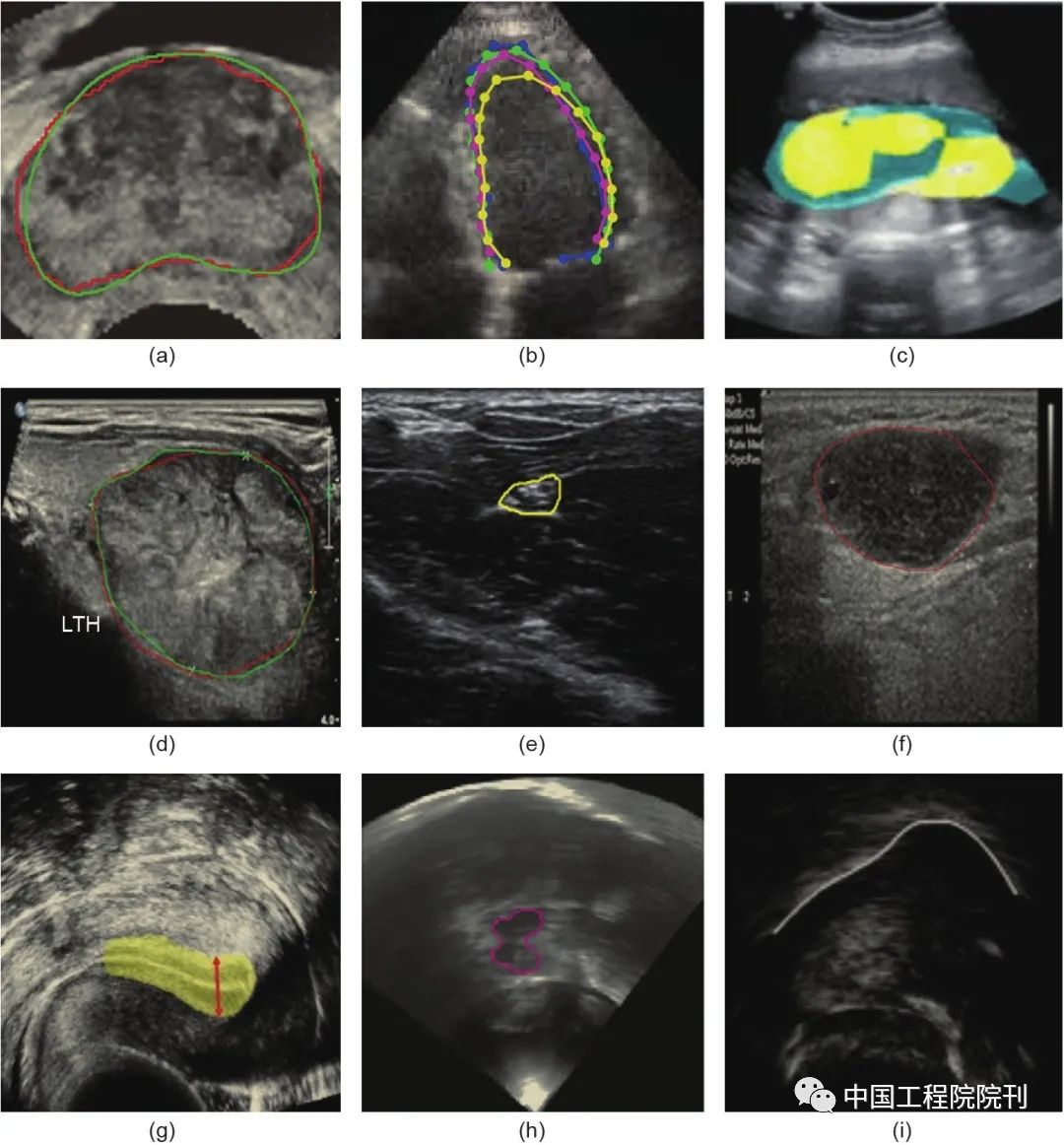 Deep Learning Applications in Medical Ultrasound Image Analysis