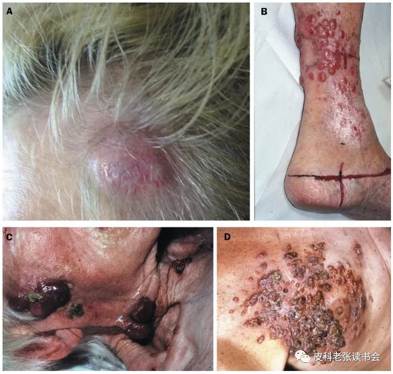 Merkel Cell Carcinoma Is Not Derived From Merkel Cells!