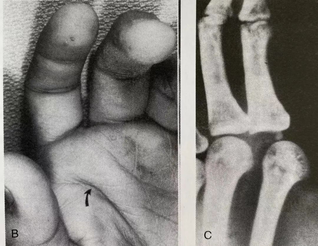 Comprehensive Summary: Treatment Strategies for Four Types of Hand Joint Injuries