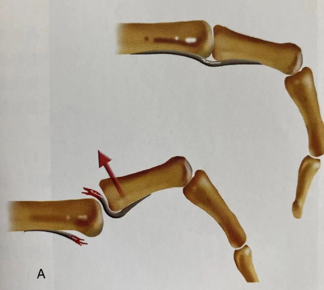 Comprehensive Summary: Treatment Strategies for Four Types of Hand Joint Injuries
