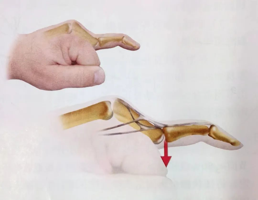 Key Points of Three Types of Hand Joint Injuries