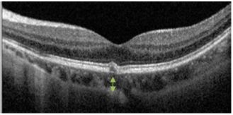 Understanding Multifocal Choroiditis Through Angio-OCT