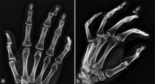 Key Points of Three Types of Hand Joint Injuries
