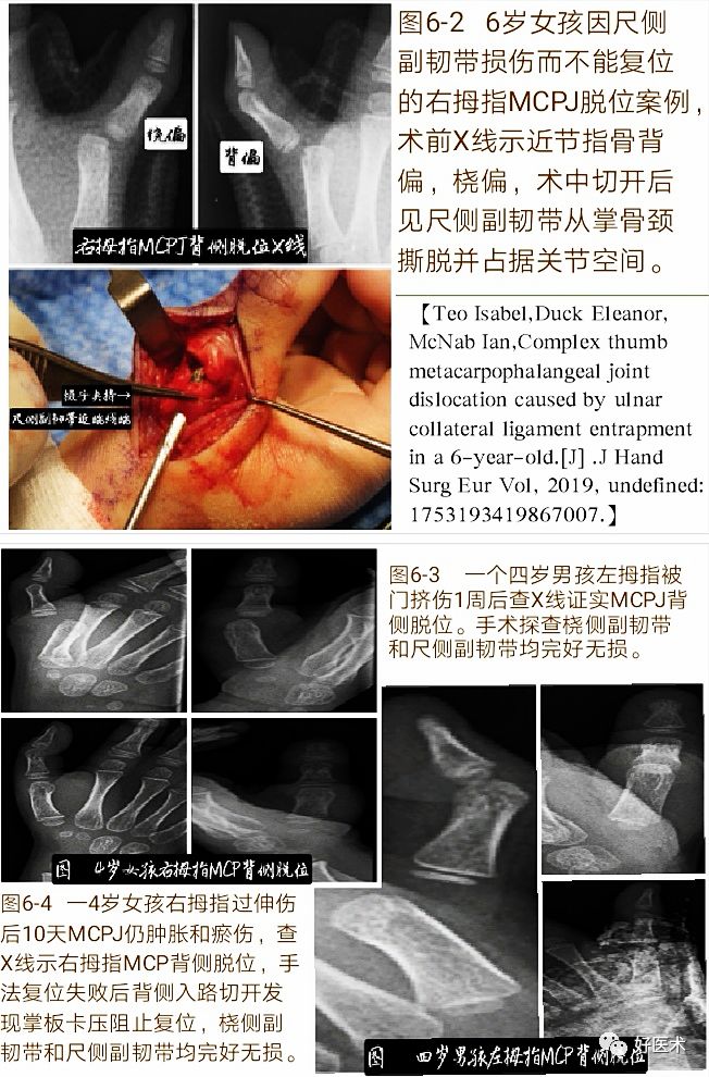 Key Points in the Diagnosis and Treatment of Metacarpophalangeal Joint Dislocation