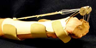 MCP And PIP Joint Arthroplasty - AAOS Orthopedic Postoperative Rehabilitation Guidelines